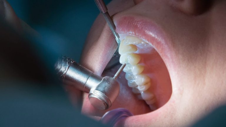 Derribando mitos sobre la endodoncia